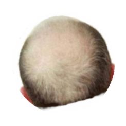 Side male thinning hair where