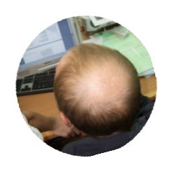  also baldness solution scalp pieces